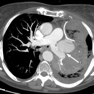 Axial Chest Computed Tomography Angiography Shows Pulmonary Artery