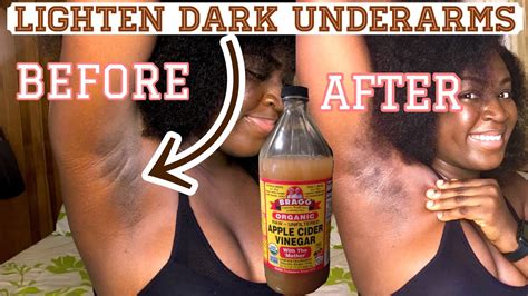 How To Lighten Dark Underarm Permanently Apple Cider For Dark Underarms Youtube