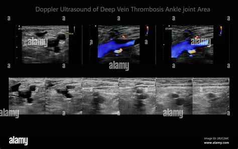 Determinación por ultrasonido Doppler color en pacientes con trombosis