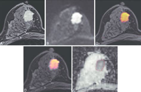 Images of a 45-y-old patient with an invasive ductal carcinoma of the ...