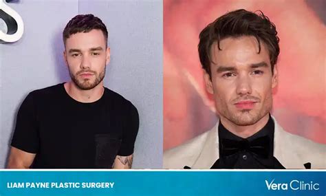 Liam Payne Plastic Surgery: Unveiling the Truth