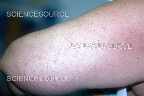 Photograph Pityriasis Rubra Pilaris Science Source Images