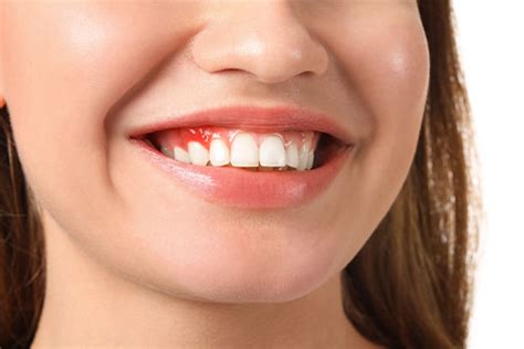 Gum Bleaching Restoring Confidence In Your Smile Theamberpost