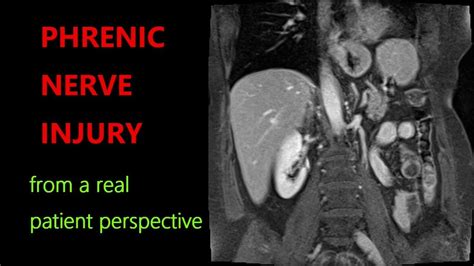 Phrenic Nerve Injury Paralyzed Diaphragm Symptoms Treatments Meded