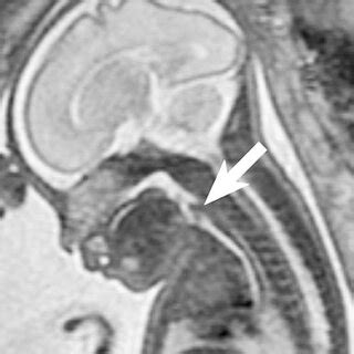 Sagittal Single Shot Fast Spin Echo Ssfse T W Image Depicts A Normal