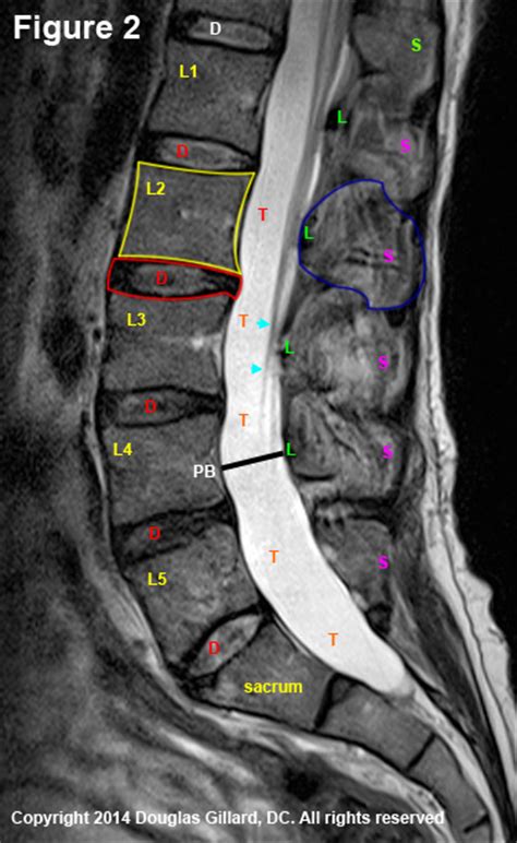 Mri Lumbar Spine Sagittal View