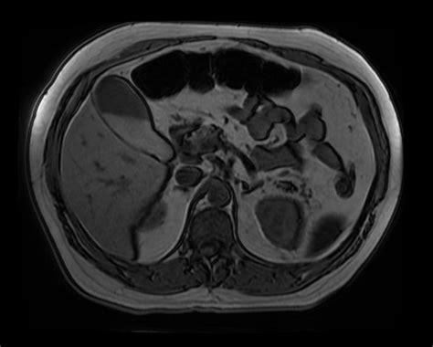 Gallbladder Sludge Image Radiopaedia Org