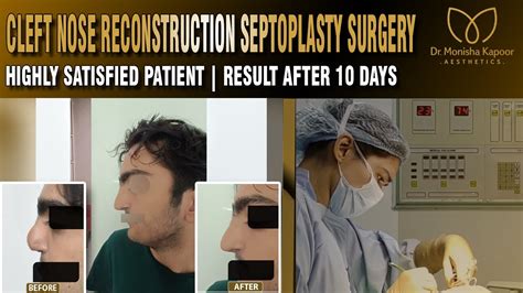 Cleft Nose Reconstruction And Septoplasty Delhi India Nose Job By Dr