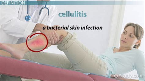 What Is Cellulitis Definition Causes Symptoms Treatment Lesson