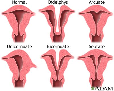 Developmental Disorders Of The Female Genital Tract Uf Health