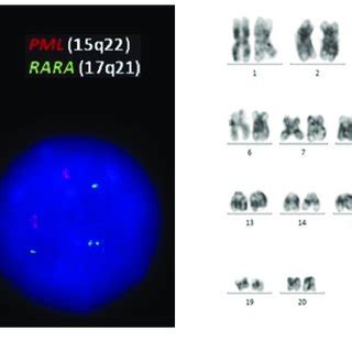 A FISH Analysis Of The Patient The Vysis Probe Set Showed Two