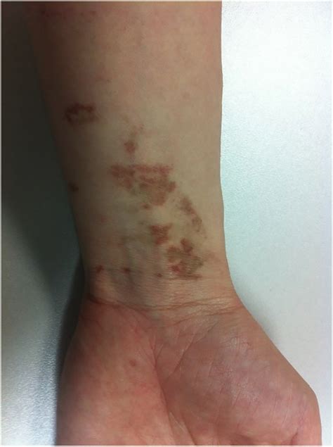 The Rash That Becomes Purpuric Petechial Hemorrhagic Or Ecchymotic