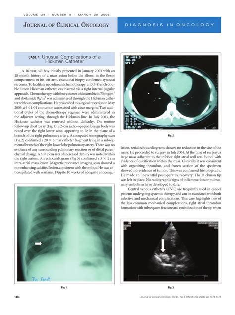 (PDF) CASE 1. Unusual Complications of a Hickman Catheter