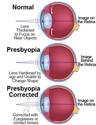 Presbyopia (need for reading glasses) - Christopherson Eye Clinic