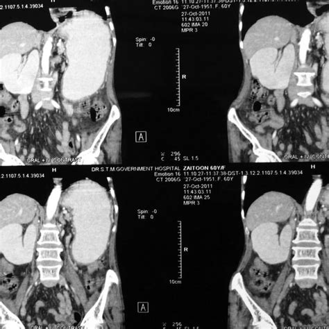 Cect Abdomen Showing A Dilated Stomach And First Second Third And Download Scientific Diagram