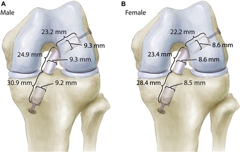 Posterior Single Incision Semitendinosus Harvest For A Quadrupled