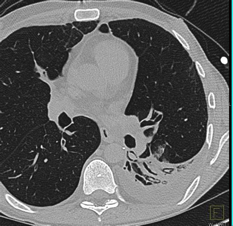 Bronchiectasis With Mucus Plugging Left Lower Lung Chest Case Studies