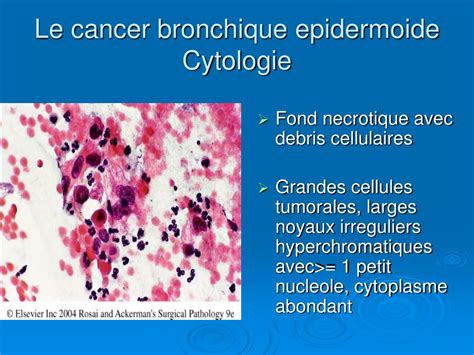 Ppt Cancers Bronchopulmonaires Powerpoint Presentation Free Download