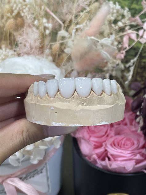 The perfect smile | Porcelain veneers, Perfect smile, Veneers
