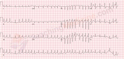 Teaching Medicine - Tutorial: Rhythm Diagnostic Criteria