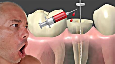 Acidente Durante O Canal Dent Rio Hipoclorito Extravasou E Agora