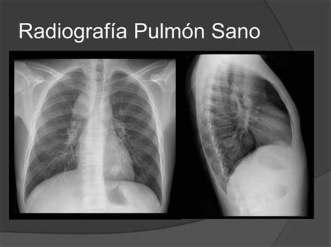 Enfisema Pulmonar Ppt