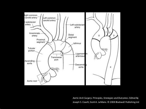 Complex Aortic Arch Surgery