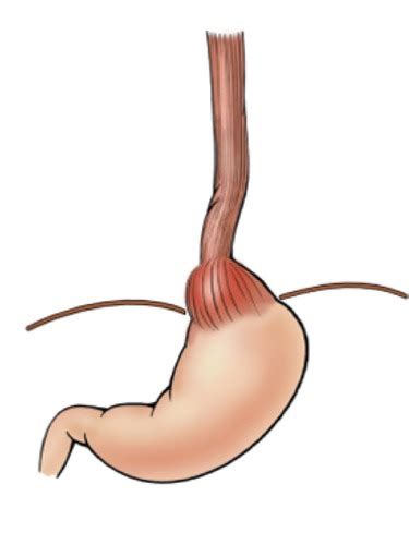 Upper Gi Pathology Flashcards Quizlet