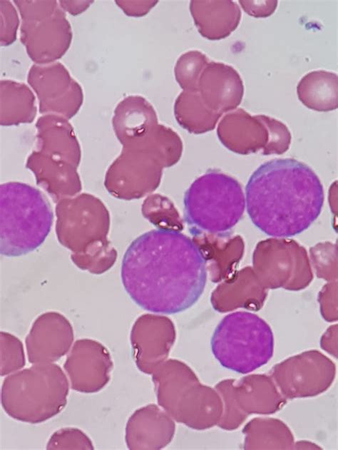 Leucemia Mieloide Aguda M2 Caso Clinico Hemoclass Hematologia E