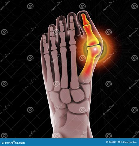Toe Deformation, Also Known As Hallux Valgus, or Bunion Stock