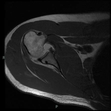 Bankart Lesion Radiology Case Radiopaedia Org