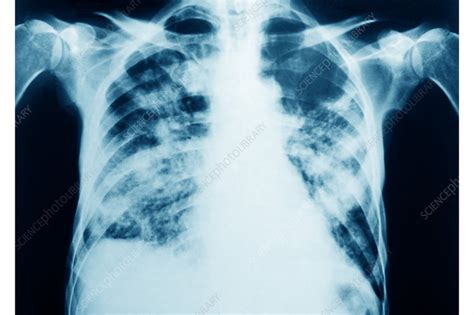 Pneumocystis Pneumonia Pcp X Ray Stock Image C038 9055 Science Photo Library