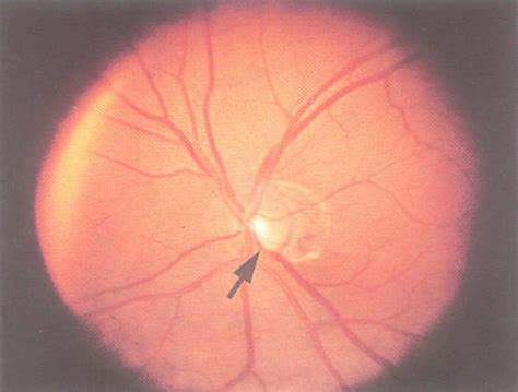 The Optic Nerve in Glaucoma | IntechOpen