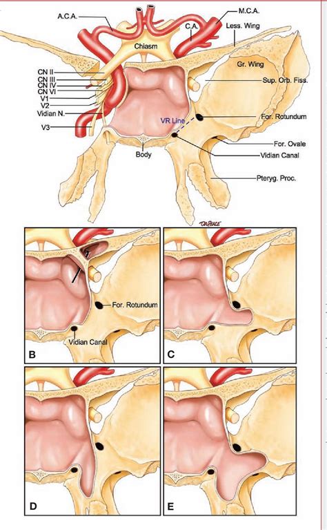 [pdf] Extensions Of The Sphenoid Sinus A New Classification Semantic