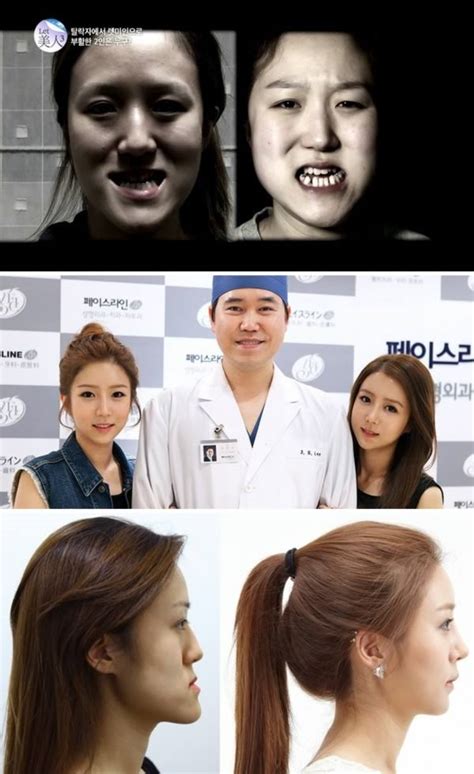 Korean Plastic Surgery Before And After Twins