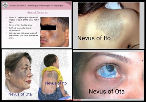 Nevus Of Ota And Ito Autoimmune Disorder Medical Assistant Skin