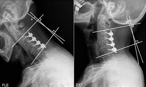 Comparison of posterior approach surgical techniques for cervical