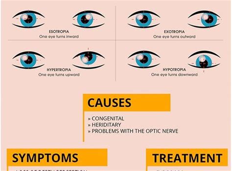 Strabismus – causes, types, diagnostics. Can strabismus be treated ...