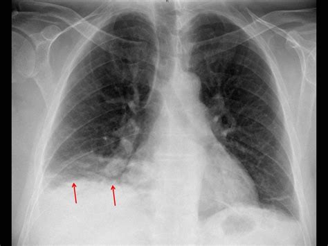 Pulmonary Infarction What Should I Look For Eurorad