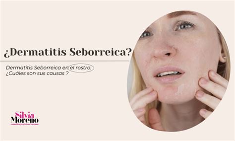 Dermatitis Seborreica Cara Tratamiento Y Causas Efectivas