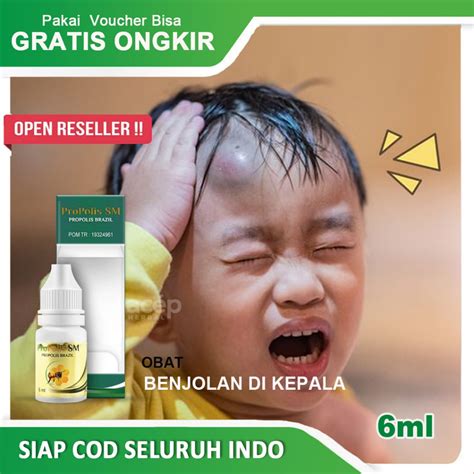 Jual Obat Benjolan Di Kepala Obat Alami Untuk Benjolan Di Kulit