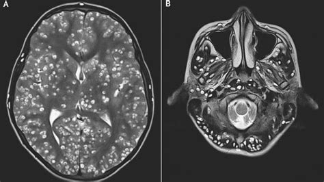 Imaging Features Of Neurocysticercosis A Radiologic Clinical Correlation ~ Neurosalud Munay