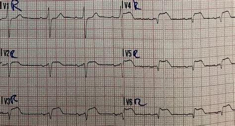 Acute Inferior Stemi With Right Ventricular Infarction And Cardiac ...