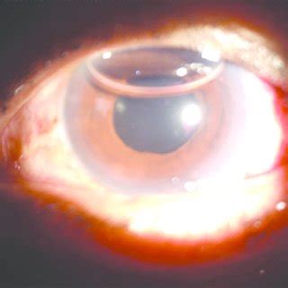 Slit Lamp Photo Of The Left Eye On Post Operative Day Showing A