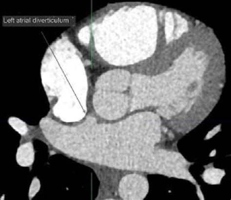 Atrial Commotio Cordis After Blunt Chest Trauma And Left Atrial