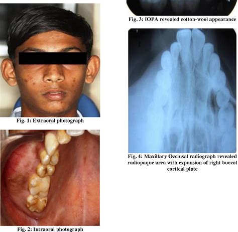 Fibrous Dysplasia Of Maxilla