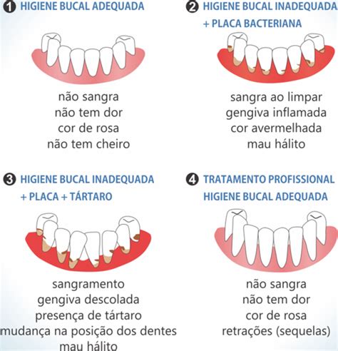 Dentes Moles Na Fase Adulta Guia São Roque