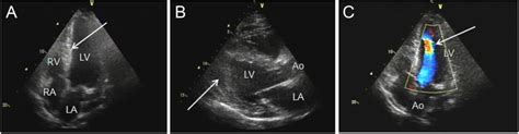 Two Dimensional Echocardiograms A Apical Four Chamber View Of The