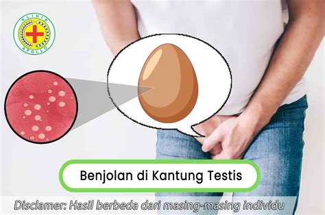 Mengatasi Benjolan Di Kantung Testis Apa Yang Perlu Diketahui