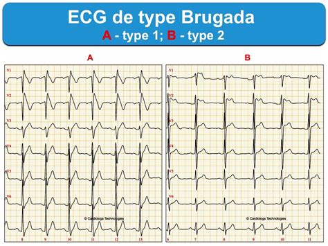 Syndrome De Brugada 1 Généralités E Cardiogram